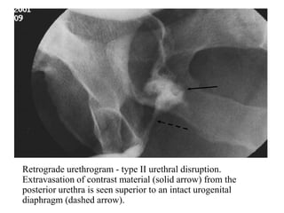 Imaging in genitourinary trauma | PPT
