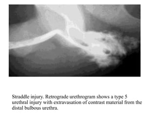 Trauma Urethrogram Imaging in genitourinary trauma | PPT