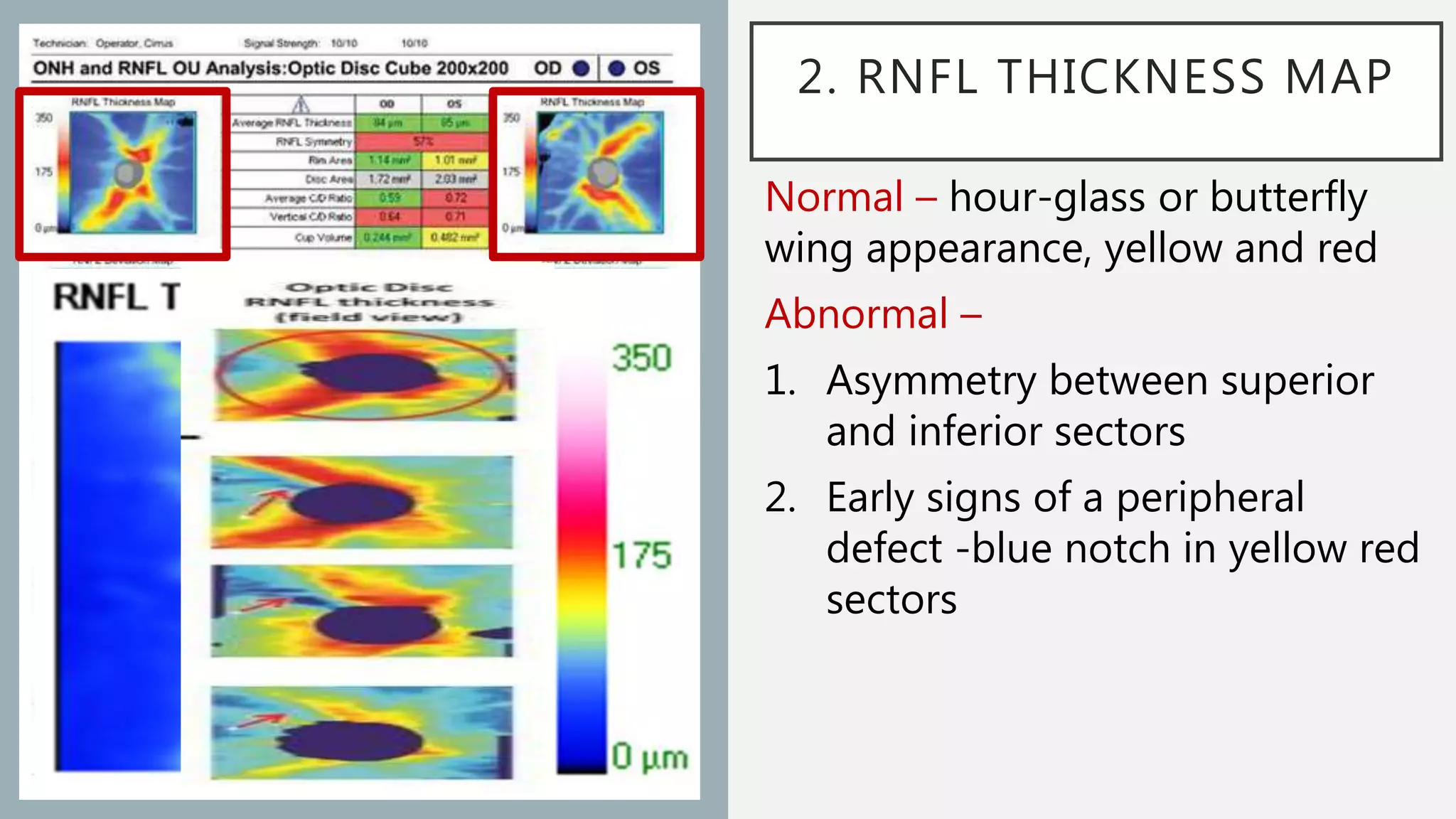 Imaging in Glaucoma | PPTX