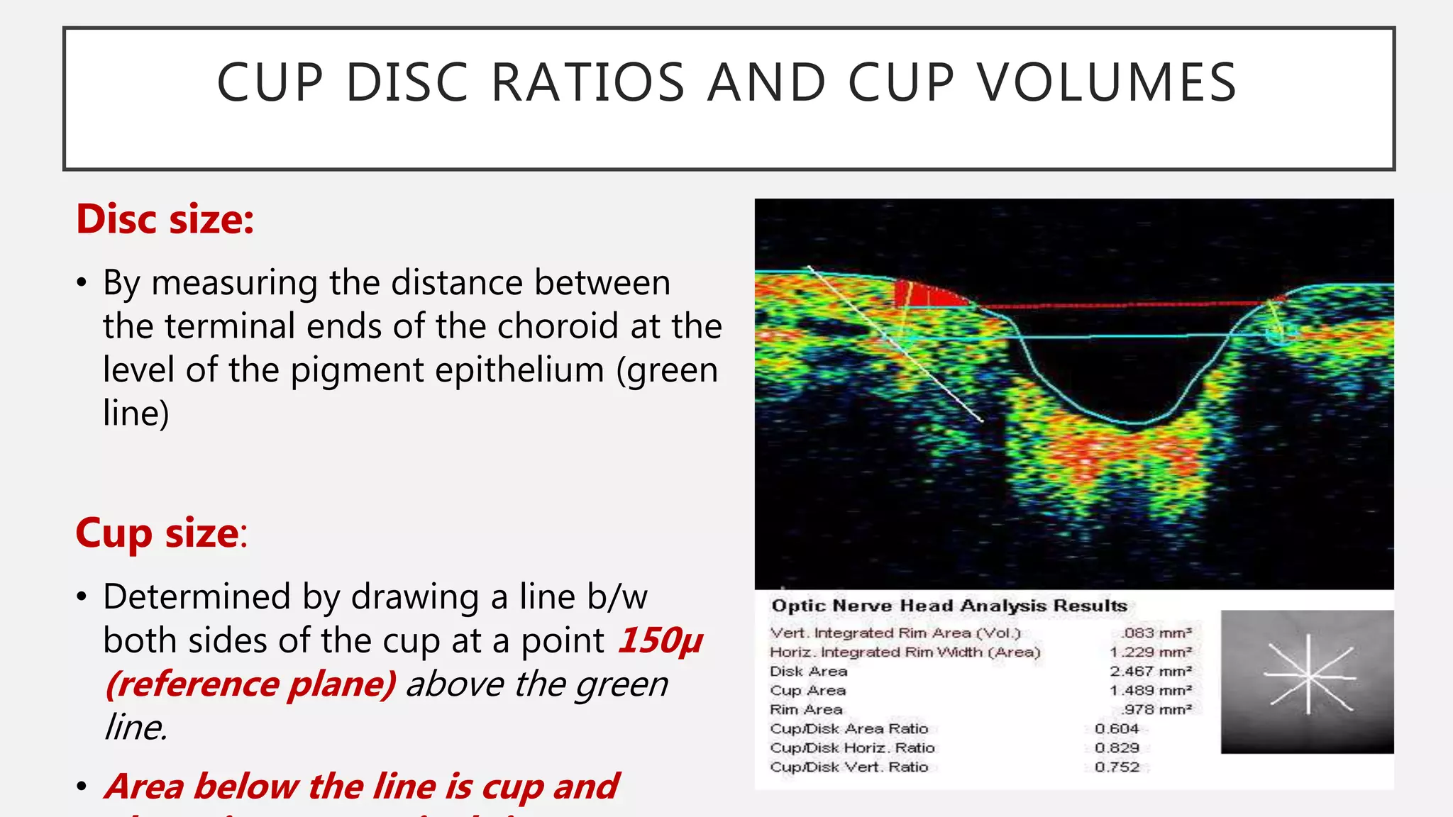 Disc Measurement Imaging in Glaucoma | PPTX