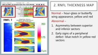 Imaging in Glaucoma | PPTX