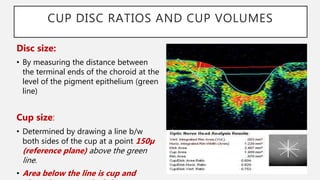 Imaging in Glaucoma | PPTX