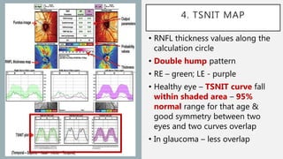 Imaging in Glaucoma | PPTX