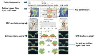 imaging in glaucomaaaaaaaa dr paras.pptx