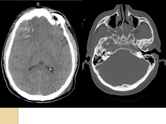 Imaging in head trauma | PPT