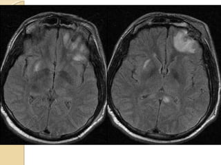 Axial FLAIR imagesAxial FLAIR images
 