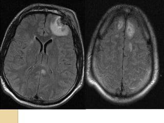 AXIAL FLAIRAXIAL FLAIR
 