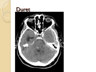 DuretDuret
 
