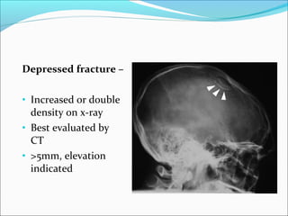 Depressed fracture –
• Increased or double
density on x-ray
• Best evaluated by
CT
• >5mm, elevation
indicated
 