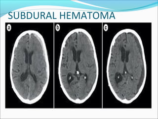 SUBDURAL HEMATOMA
 