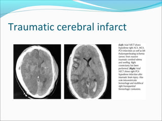 Traumatic cerebral infarct
 
