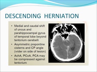 DESCENDING HERNIATION
 