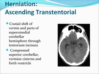 Herniation:
Ascending Transtentorial
Cranial shift of
vermis and parts of
superomedial
cerebellar
hemisphere through
tentorium incisura
 Compressed
superior cerebellar,
vermian cisterns and
forth ventricle
 