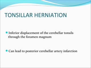 TONSILLAR HERNIATION
Inferior displacement of the cerebellar tonsils
through the foramen magnum
Can lead to posterior cerebellar artery infarction
 