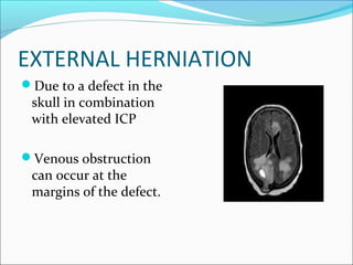 EXTERNAL HERNIATION
Due to a defect in the
skull in combination
with elevated ICP
Venous obstruction
can occur at the
margins of the defect.
 