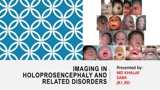 IMAGING IN
HOLOPROSENCEPHALY AND
RELATED DISORDERS
Presented by:
MD KHALAF
SABA
JR1,RD
 