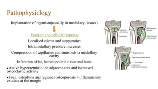Intramedullary Bone Infarct Imaging in infections of bones and joints2.pptx