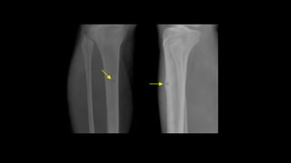 Imaging in infections of bones and joints2.pptx