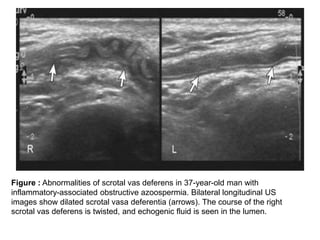 Vasogram Imaging in infertility | PPTX
