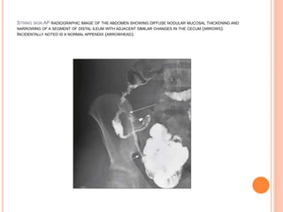 Small Intestine String. Sign Imaging in Inflammatory Bowel Disease | PPTX