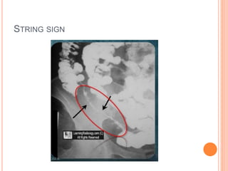 Small Intestine String. Sign Imaging in Inflammatory Bowel Disease | PPTX