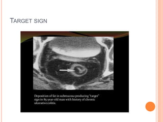 Imaging in Inflammatory Bowel Disease | PPTX