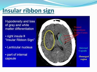 Insular ribbon sign
 Hypodensity and loss of
gray and white matter
differentiation
• right insula
 “Insular Ribbon Sign”
 