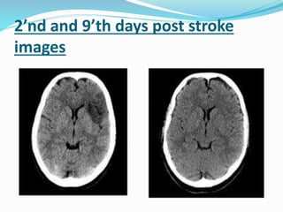2’nd and 9’th days post stroke
images
 