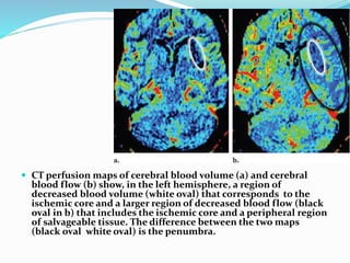  CT perfusion maps of cerebral blood volume (a) and cerebral
blood flow (b) show, in the left hemisphere, a region of
decreased blood volume (white oval) that corresponds to the
ischemic core and a larger region of decreased blood flow (black
oval in b) that includes the ischemic core and a peripheral region
of salvageable tissue. The difference between the two maps
(black oval white oval) is the penumbra.
 