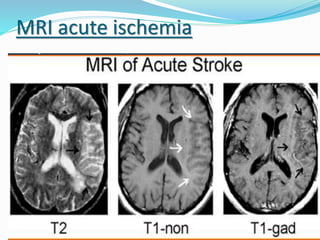 MRI acute ischemia
 