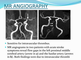 MR ANGIOGRAPHY
 Sensitive for intravascular thrombus.
 MR angiograms in two patients with acute stroke
symptoms reveal flow gaps in the left proximal middle
cerebral artery (arrow in a) and the basilar artery (arrows
in b). Both findings were due to intravascular thrombi
 