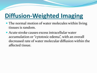 Diffusion-Weighted Imaging
 The normal motion of water molecules within living
tissues is random.
 Acute stroke causes excess intracellular water
accumulation or “cytotoxic edema”, with an overall
decreased rate of water molecular diffusion within the
affected tissue.
 