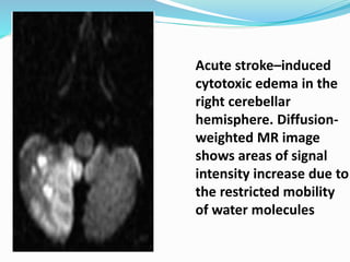 Acute stroke–induced
cytotoxic edema in the
right cerebellar
hemisphere. Diffusion-
weighted MR image
shows areas of signal
intensity increase due to
the restricted mobility
of water molecules
 