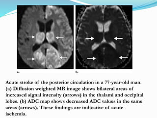 Acute stroke of the posterior circulation in a 77-year-old man.
(a) Diffusion weighted MR image shows bilateral areas of
increased signal intensity (arrows) in the thalami and occipital
lobes. (b) ADC map shows decreased ADC values in the same
areas (arrows). These findings are indicative of acute
ischemia.
 