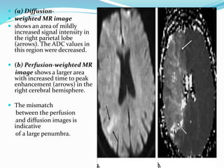  (a) Diffusion-
 weighted MR image
 shows an area of mildly
increased signal intensity in
the right parietal lobe
(arrows). The ADC values in
this region were decreased.
 (b) Perfusion-weighted MR
image shows a larger area
with increased time to peak
enhancement (arrows) in the
right cerebral hemisphere.
 The mismatch
between the perfusion
and diffusion images is
indicative
of a large penumbra.
 