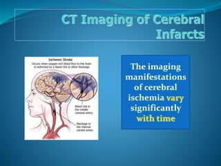 The imaging
manifestations
of cerebral
ischemia vary
significantly
with time
 