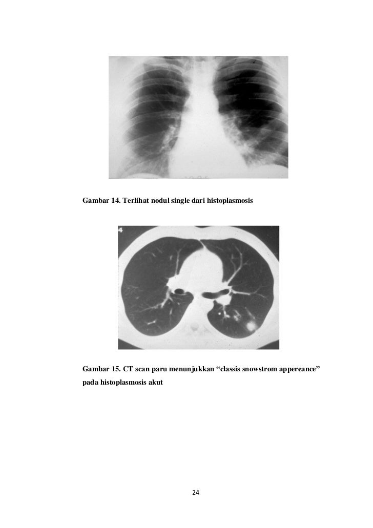 Imaging in lung fungal infection