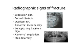 Fragmented Sign IMAGING MODALITIES IN ORAL AND MAXILLOFACIAL TRAUMA.pptx