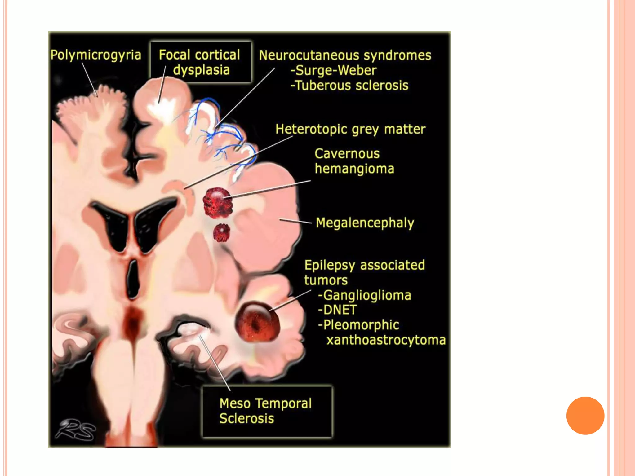 Imaging in MESIAL TEMPORAL EPILESPY | PPTX