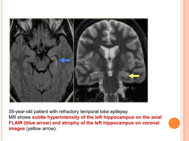 Imaging in MESIAL TEMPORAL EPILESPY | PPTX