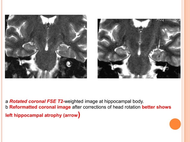 Imaging in MESIAL TEMPORAL EPILESPY | PPTX