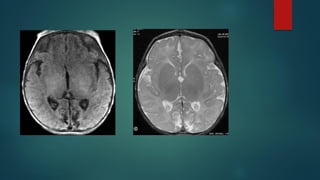 imaging in neonatal brain.pdf recommendation the use of mri brain of ...