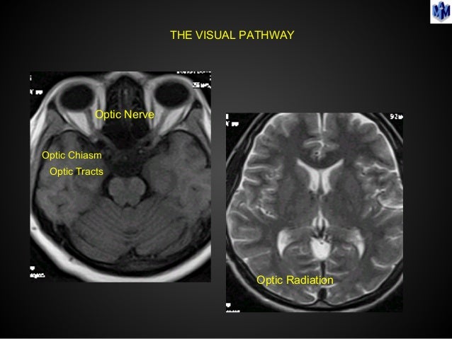 Imaging in neuro ophthalmology & revisting orbital imaging.2012 (1)