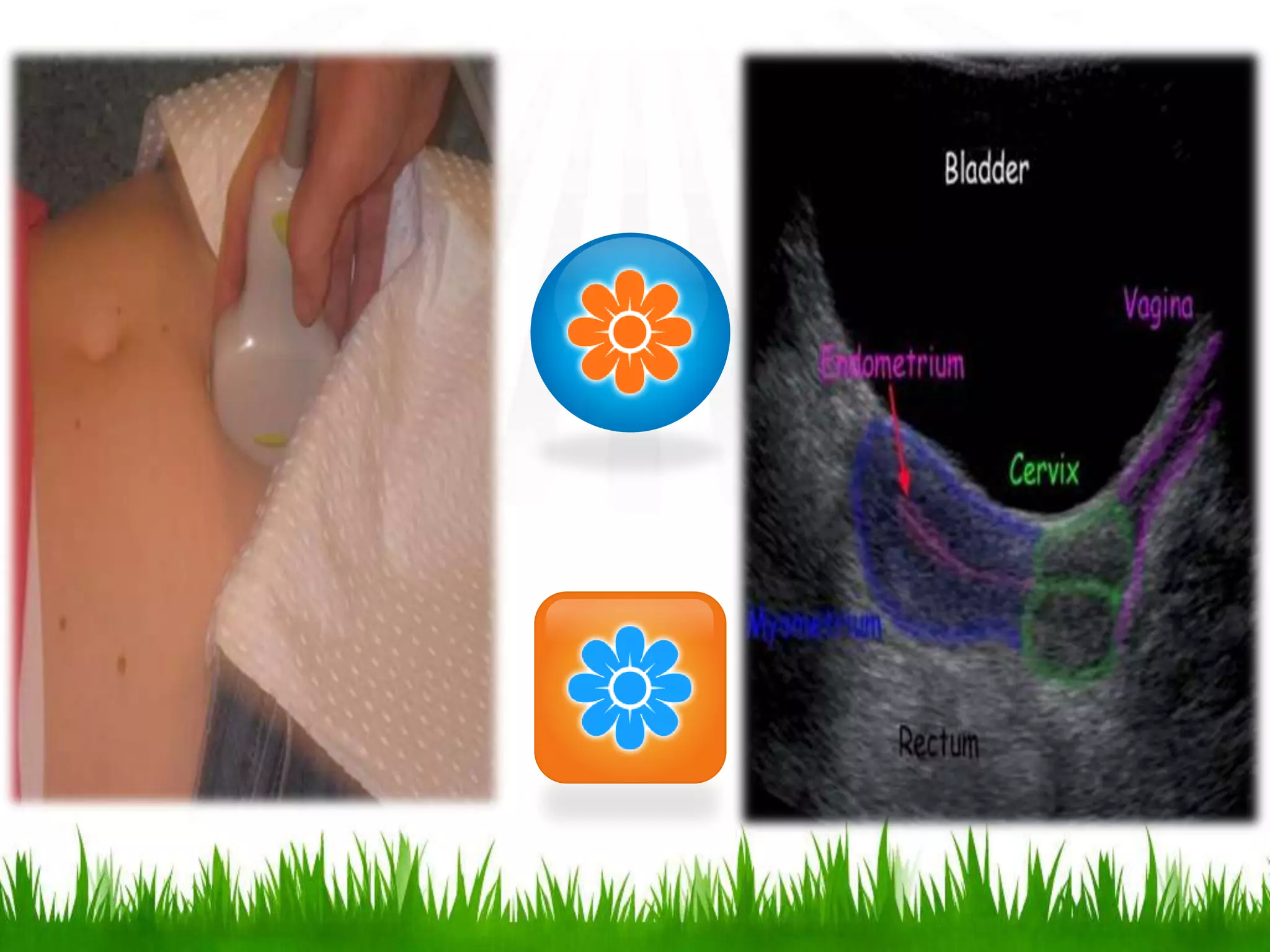 Imaging in obstetrics & gynaecology (part 1- Gynaecological scans in ...