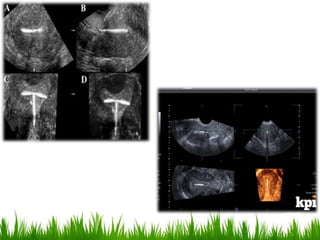 Imaging in obstetrics & gynaecology (part 1- Gynaecological scans in ...