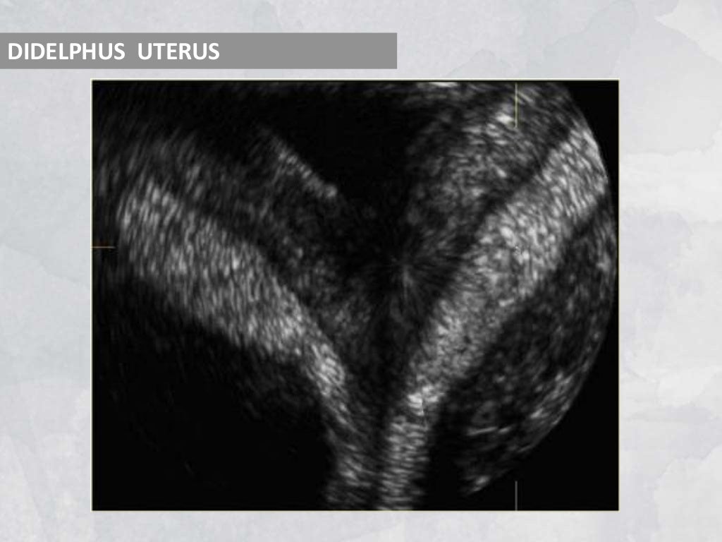 Imaging in obstetrics & gynaecology (part 1 Gynaecological scans in