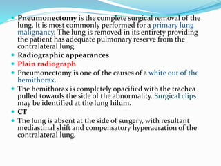  Pneumonectomy is the complete surgical removal of the
lung. It is most commonly performed for a primary lung
malignancy. The lung is removed in its entirety providing
the patient has adequate pulmonary reserve from the
contralateral lung.
 Radiographic appearances
 Plain radiograph
 Pneumonectomy is one of the causes of a white out of the
hemithorax.
 The hemithorax is completely opacified with the trachea
pulled towards the side of the abnormality. Surgical clips
may be identified at the lung hilum.
 CT
 The lung is absent at the side of surgery, with resultant
mediastinal shift and compensatory hyperaeration of the
contralateral lung.
 
