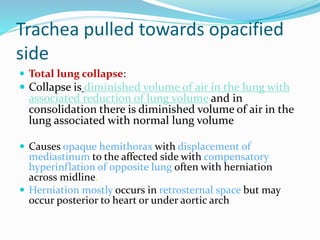 Trachea pulled towards opacified
side
 Total lung collapse:
 Collapse is diminished volume of air in the lung with
associated reduction of lung volume and in
consolidation there is diminished volume of air in the
lung associated with normal lung volume
 Causes opaque hemithorax with displacement of
mediastinum to the affected side with compensatory
hyperinflation of opposite lung often with herniation
across midline.
 Herniation mostly occurs in retrosternal space but may
occur posterior to heart or under aortic arch
 
