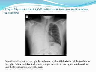X ray of 35y male patient K/C/O testicular carcinoma on routine follow
up scanning.
Complete white out of the right hemithorax , with mild deviation of the trachea to
the right. Subtle endoluminal mass is appreciable from the right main bronchus
into the lower trachea above the carin
 