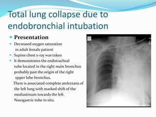 Total lung collapse due to
endobronchial intubation
 Presentation
 Decreased oxygen saturation
in adult female patient
 Supine chest x-ray was taken
 It demonstrates the endotracheal
tube located in the right main bronchus
probably past the origin of the right
upper lobe bronchus.
There is associated complete atelectasis of
the left lung with marked shift of the
mediastinum towards the left.
Nasogastric tube in situ.
 